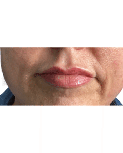 After Image: Lip Filler