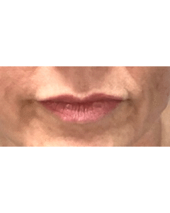 Before Image: Lip Filler