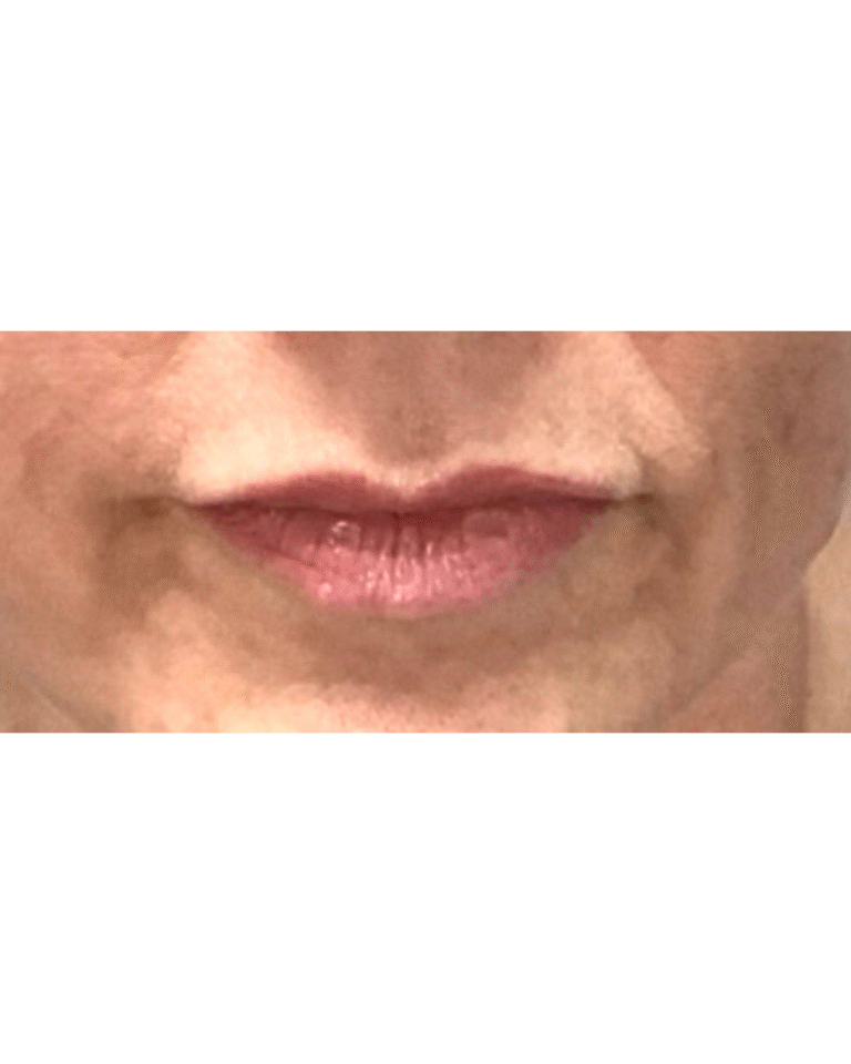 Before Image: Lip Filler - front