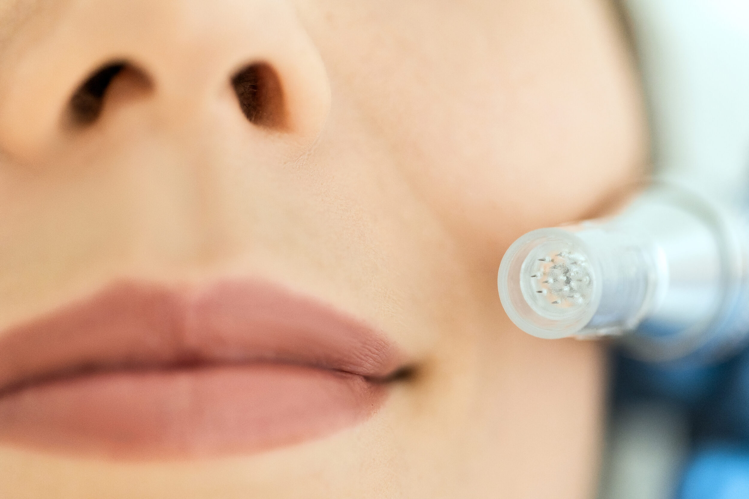 Dermapen skin needling treatment ,lips close up