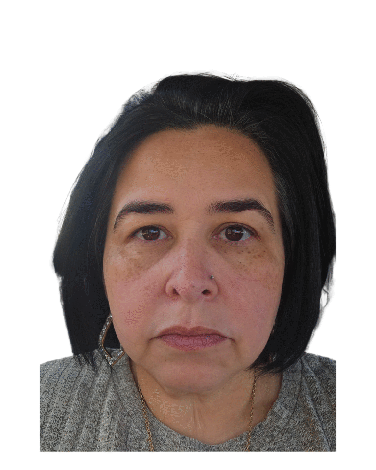 After Image: Microneedling - front