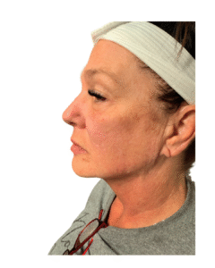 After Image: Thread Lift