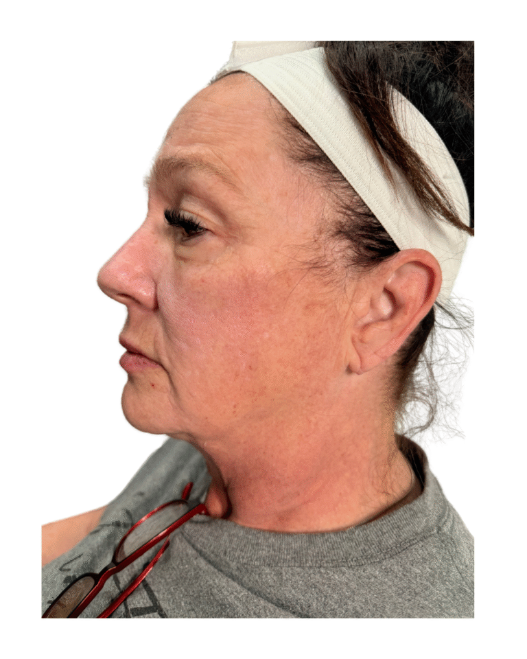 Before Image: Thread Lift - left-side