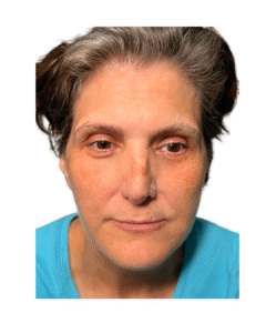 Before Image: Thread Lift