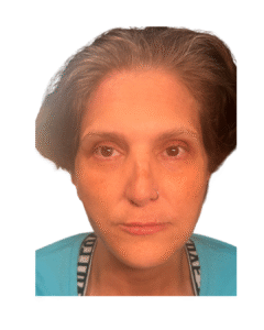 After Image: Thread Lift