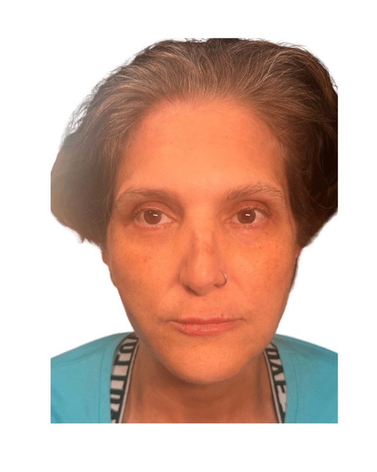 After Image: Thread Lift - front